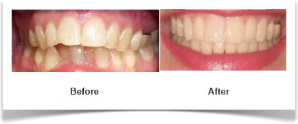 Orthodontic Before - After