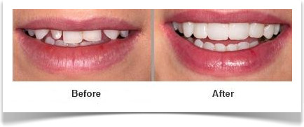 EDELWEISS before after