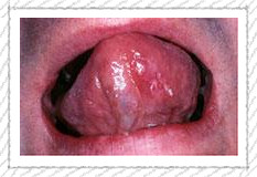 oral cancer