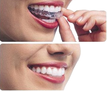 Invisalign