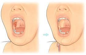 oral cancer