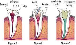 Root Canal
